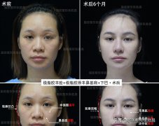 下顎填充整形需多少錢(下顎整形費用)