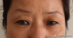 眉毛整形手術(shù)要多少錢一次(眉毛整形手術(shù)要多少錢一次費用)