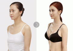 乳腺腺體手術(shù)加整形多少錢(qián)(乳腺癌整形手術(shù)需要多少費(fèi)用)