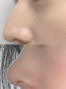 鷹鉤鼻子整形要多少錢(鷹鉤鼻子整形要多少錢費用)
