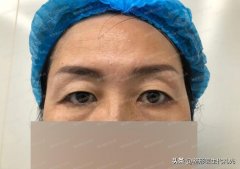 做提眉整形價格多少(整形醫(yī)院提眉多少錢)
