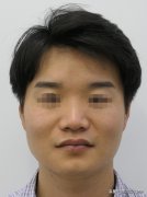 寬鼻背鼻整形多少錢(寬鼻矯正價格)