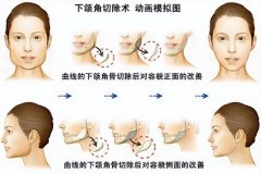 下巴過(guò)長(zhǎng) 整形要多少錢