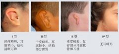 外耳整形得多少錢(外耳整形得多少錢一次)