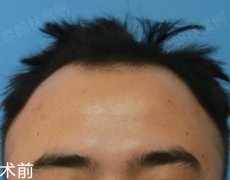 發(fā)際線整形價格一般多少(整容發(fā)際線多少錢)