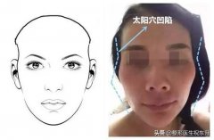 頭骨輪廓整形費用多少呢(額骨整形需要多少錢)