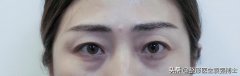 網(wǎng)爆眼部整形費用大概多少(眼部整形需要多少錢 哪里便宜些)