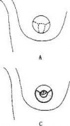 乳頭整形要花多少錢(乳房整型需要多少錢)