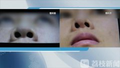 南京鼻子整形需要多少錢(整鼻子大概多少費(fèi)用南京)