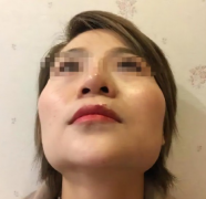 顴骨太寬整形要多少錢呢(顴骨太寬做手術(shù)大概多少錢)