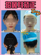 招風(fēng)耳整形一般多少錢一只(招風(fēng)耳整形一般多少錢一只)