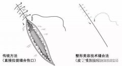 美容整形縫針價格多少(美容整形縫針價格多少)