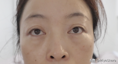 去眼袋整形手術(shù)費多少(去眼袋整形手術(shù)費多少)
