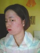 醫(yī)美整形痘痕修復(fù)費(fèi)用多少(痘痘疤痕修復(fù)手術(shù)一般多少錢)