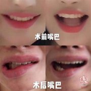 嘴部整形多少天能恢復(嘴角整形恢復期要多久)