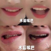整形嘴唇要多少錢(整形手術(shù)嘴唇多少錢)