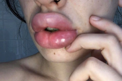 嘴巴整形要花多少錢費(fèi)用(整容嘴巴大概需要多少錢)