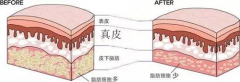 乳頭縮短整形多少錢(乳頭縮短整形多少錢一次)