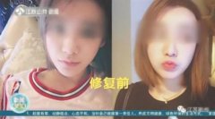 醫(yī)療整容整形鼻子多少錢(整形鼻子費用)
