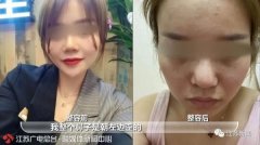 南京鼻頭整形多少錢(qián)(南京鼻部整形)