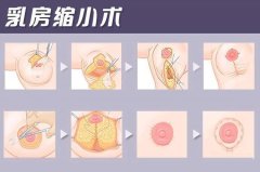 胸部下垂整形修復(fù)費(fèi)用多少(胸部下垂整形修復(fù)費(fèi)用多少)