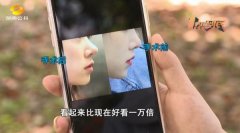 豬鼻子整形多少錢(豬鼻子整形多少錢)