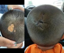 頭部瘢痕整形多少錢(頭型整形需要多少錢)