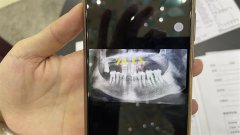 做整形牙齒多少錢(做整形牙齒多少錢一顆)