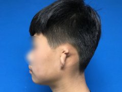 外耳整形費用多少錢(耳朵假體手術多少錢)
