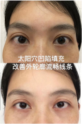 鄭州集美整形祛眼袋多少錢(整形醫(yī)院去眼袋一般多少錢)