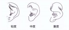 菜花耳整形多少錢(菜花耳整形多少錢一顆)