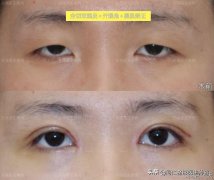 微雕整形雙眼皮多少錢(微整割雙眼皮)