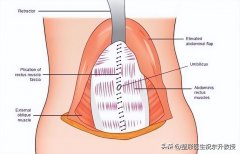 整形腹壁多少錢(腹壁整形要多少錢)