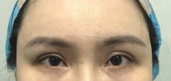 眼窩深整形手術(shù)多少錢(深眼窩割雙眼皮圖片)