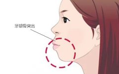 突嘴整形得多少錢(凸嘴整形一般多少錢)