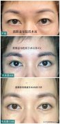 眼部整形多少錢比較合理呢(眼部整形大概要多少錢)