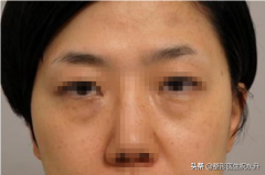 眼袋整形價格要多少(眼袋整形費用一般是多少錢)
