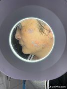 激光整形多少錢(激光美容多少錢)
