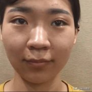 縮鼻翼手術(shù)整形多少錢(做縮小鼻翼手術(shù)是多少錢)