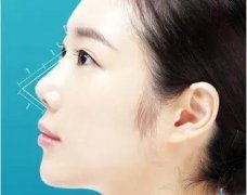 鼻子縮短整形手術多少錢(鼻子拉長手術多少錢)
